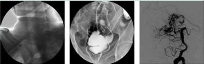 x-ray imaging by medical x-ray intensifier